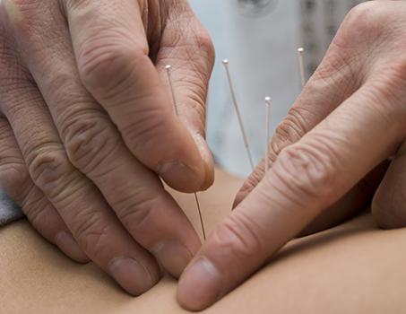 acupuncture